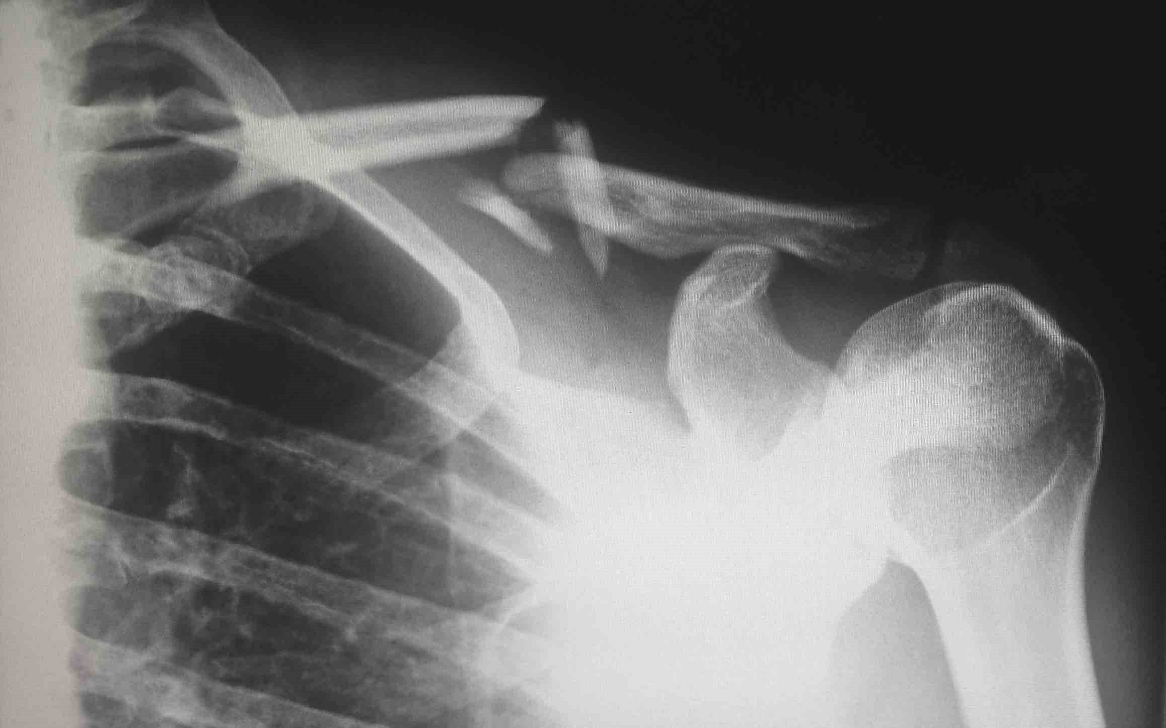 Personal Injuries and Broken Bones: Understanding Different Types of Fractures